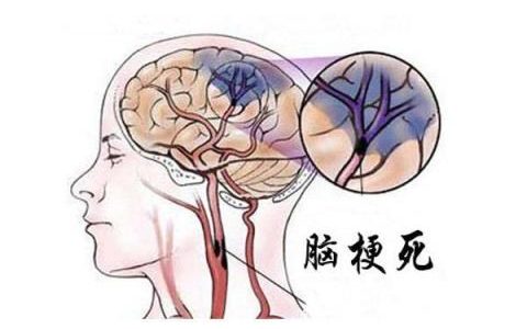 大脑缺氧的症状,人的大脑缺氧是什么症状？
