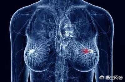 乳腺包块，乳腺包块会变癌吗为什么