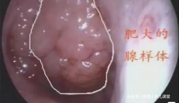 中国过敏与哮喘网官网腺样体肥大