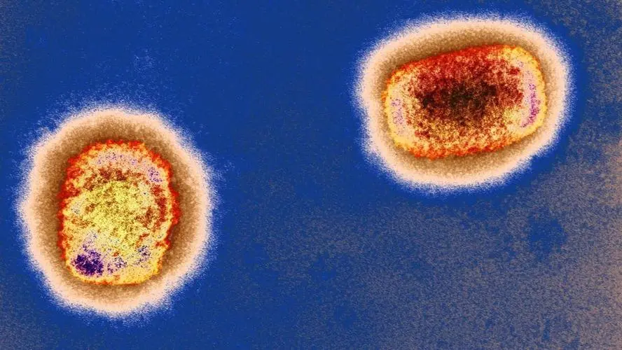 猴痘病毒传播速度前所未有，致死率高达11%，为何爆发如此巧合？