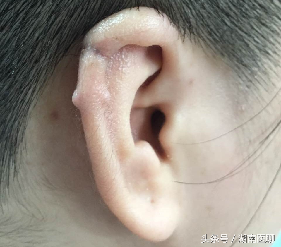 为什么有人打耳洞后肿起一坨？如何护理耳洞不肿不发炎？