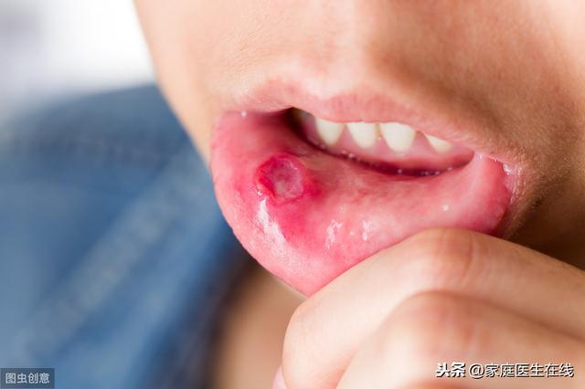 经常口腔溃疡是什么原因引起的（满嘴口腔溃疡什么原因）